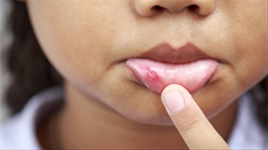 Lở miệng lưỡi liên tục do đâu và cách nào để nhanh hết bệnh?