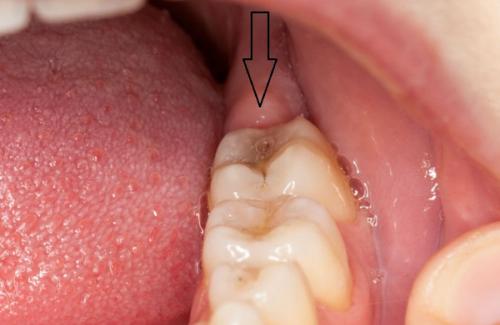 Mẹo siêu lợi hại giúp răng tự mọc trở lại mà không cần trồng răng giả hay hàn răng cực khổ