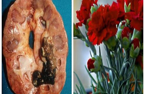 Khoa học chứng mình Hoa cẩm chướng là khắc tinh của 4 căn bệnh chết người thường gặp