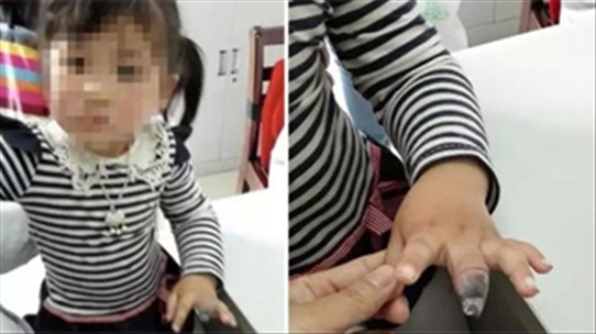 Cẩn trọng với xước măng rô ở trẻ, không khéo ngón tay cũng mất luôn, như cô bé 4 tuổi này