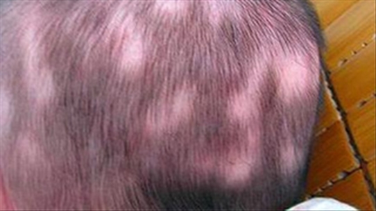 Cậu bé 4 tuổi rụng tóc nghiêm trọng, mẹ phát hoảng khi biết được nguyên nhân