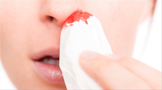 Tự nhiên chảy máu cam, dấu hiệu của nhiều bệnh về mũi