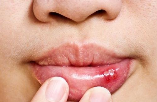Niêm mạc miệng là gì? Nguyên nhân bị viêm loét niêm mạc miệng