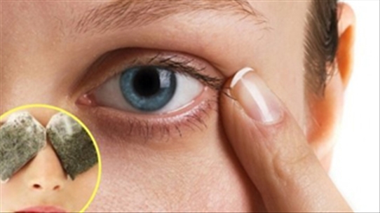 5 mẹo hay giúp giảm thâm quầng mắt có thể bạn chưa biết