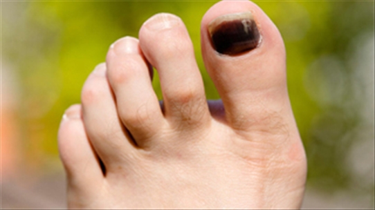 Đen móng chân không chỉ là do tụ máu, nhiều căn bệnh khác được cảnh báo từ dấu hiệu này