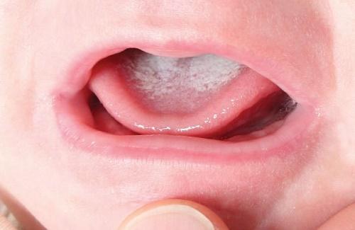 Lưỡi bé bị ĐÓNG TRẮNG là do mắc bệnh gì? Cách xử lý tình trạng này hiệu quả