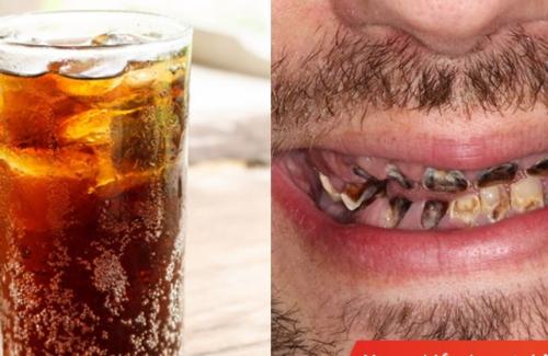 Nghiện đồ uống có ga, chàng trai phải trả giá "đắt" khi hàm không còn nổi một chiếc răng