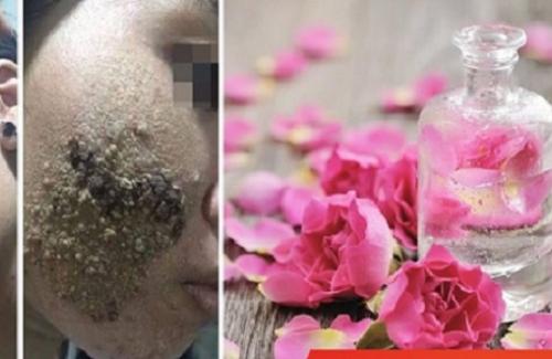 Kinh hoàng da mặt cô gái bị "tàn phá" sau khi sử dụng nước hoa hồng khiến chị em "tá hỏa"