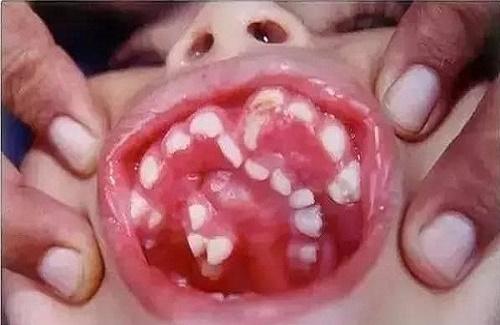 Kinh hoàng: Ăn nhiều thức ăn nhuyễn sẽ khiến trẻ mọc răng "quái vật"
