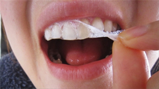 Sử dụng miếng dán làm trắng răng có thật sự tốt như bạn nghĩ