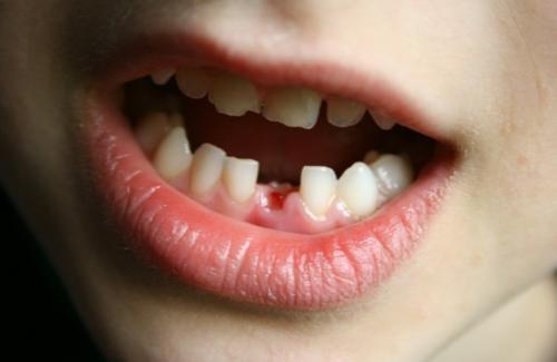 Răng sữa là gì? Sự khác biệt giữa răng sữa và răng vĩnh viễn