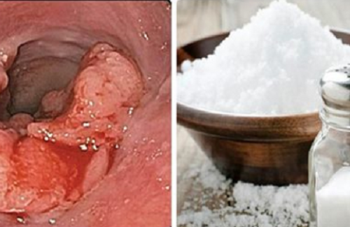 Sốc: Ăn nhiều muối chính là sát thủ gây ra 4 chứng ung thư hàng loạt người mắc phải nhất nước ta