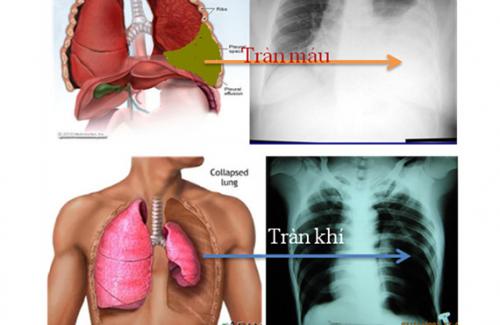 Tràn máu màng phổi là gì? Triệu chứng, nguyên nhân và điều trị bệnh