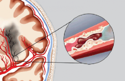 Vỡ mạch máu não là sao? Triệu chưng, nguyên nhân và cách điều trị