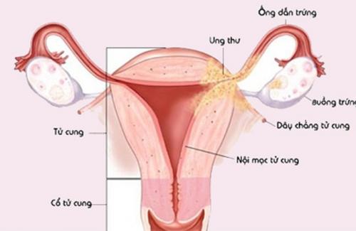 Lạc nội mạc tử cung - bệnh phổ biến trong các bệnh phụ khoa, mọi phụ nữ đều có thể mắc