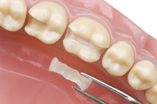 Hậu quả của mòn răng và cách phòng tránh siêu hiệu quả