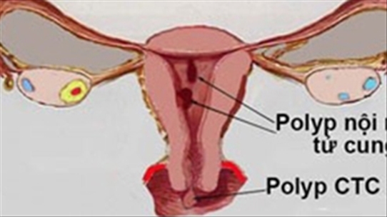 Nếu sảy thai khi bị polyp tử cung thì có những dấu hiệu nào?