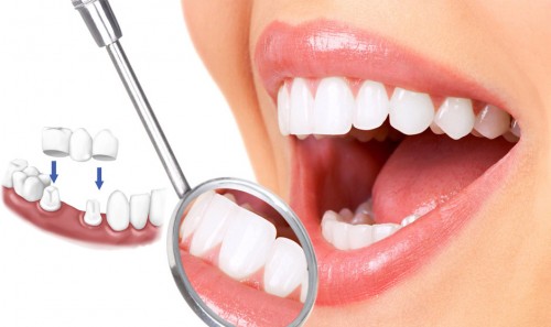 Bọc răng thẩm mỹ: Những mối nguy bạn cần phải lưu ý