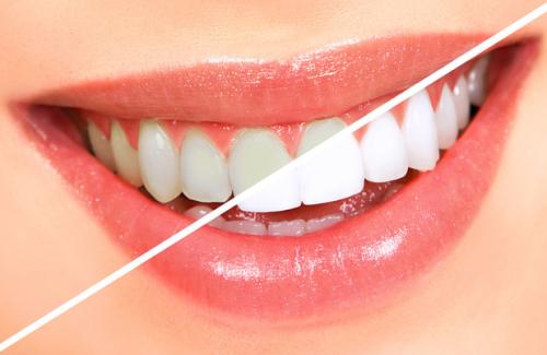 Lưu ý khi tẩy trắng răng mà bạn cần phải biết trước khi làm