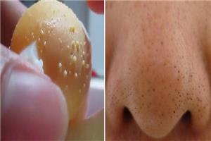 Lăn mặt bằng trứng gà luộc: chưa kịp sạch mụn đã bị viêm da