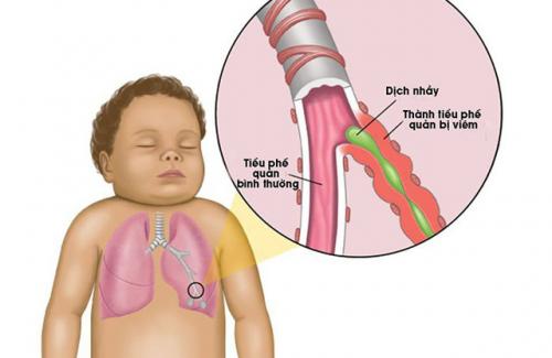 Viêm tiểu phế quản - căn bệnh thường hay gặp ở trẻ em