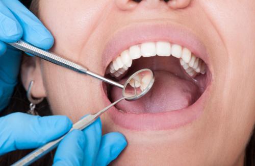 4 dấu hiệu ở răng cảnh báo sức khỏe gặp vấn đề nên chú ý