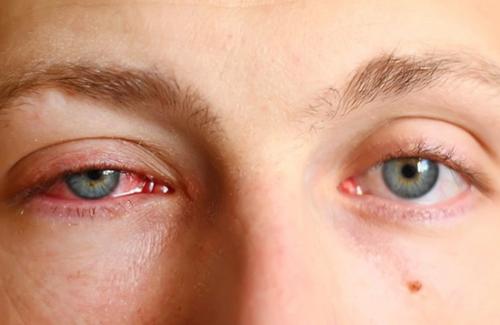 Bệnh đau mắt đỏ và cách phòng ngừa bệnh hiệu quả nhất
