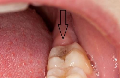 Bật mí 7 cách giúp chữa đau răng khôn hiệu quả đến không ngờ