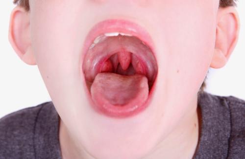 Bệnh viêm họng ở trẻ chớ coi thường để tránh gây nguy hiểm sức khỏe