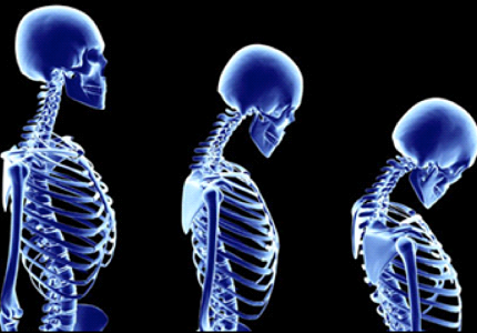 Những điều cần biết về bệnh loãng xương mà bạn nên biết