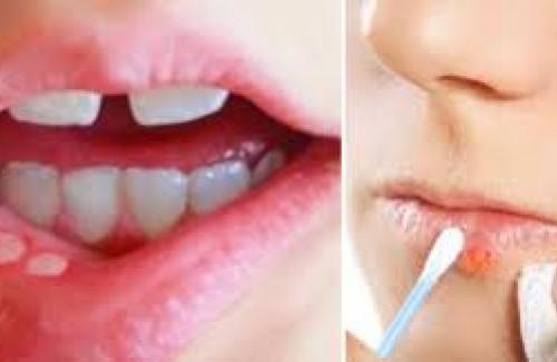 Mách nhỏ 6 cách tự nhiên chữa lở miệng bạn đừng bỏ qua