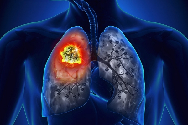 Những điều cần biết về xét nghiệm phát hiện sớm ung thư phổi