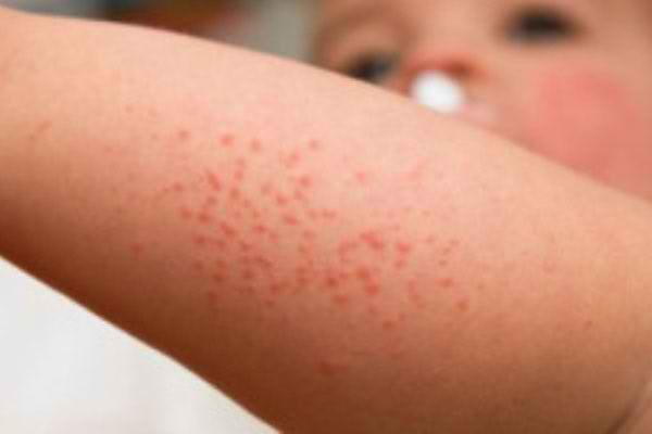 Cách xử lý da của con bạn khi bị ngứa và mẩn đỏ tại nhà