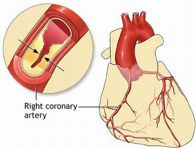 Can thiệp tim mạch cứu sống bệnh nhân không thể phẫu thuật