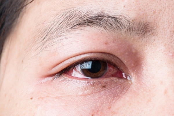 Bảo vệ mắt đúng cách trước dịch đau mắt đỏ bùng phát