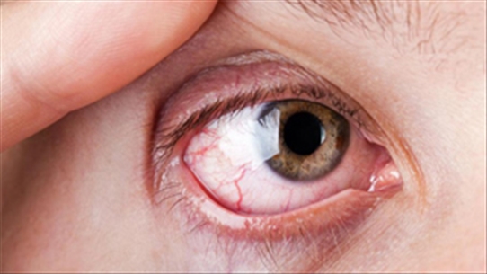 Những điều cần biết về bệnh đau mắt đỏ để bệnh không thành dịch
