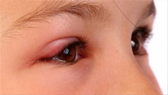 Phòng và chữa bệnh đau mắt đỏ đúng cách để bệnh nhanh thuyên giảm