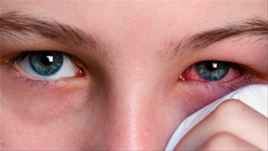 Lưu ý rửa mắt khi bị đau mắt đỏ để bệnh không thê nặng