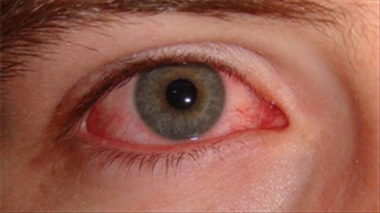 Cảnh giác: Bệnh đau mắt đỏ vào mùa dịch để bệnh dịch không lây lan