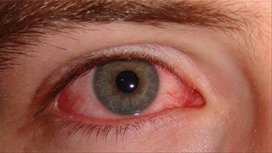 Phân loại điều trị đau mắt đỏ cơ bản để mọi người đều biết