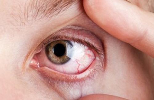 Gân đỏ xuất hiện trong lòng trắng của mắt là bệnh gì?