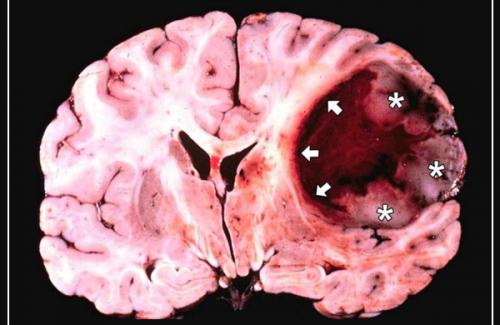 Bệnh đau nửa đầu: Tưởng chỉ đau đầu bình thường, hóa ra bị u não