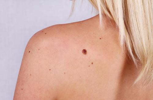 Những nốt ruồi trên cơ thể có thể là ung thư da hay không?