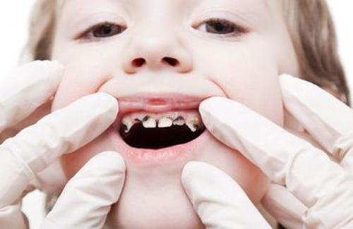 Nguyên nhân gây ra đen răng ở trẻ mà cha mẹ nhất định phải biết