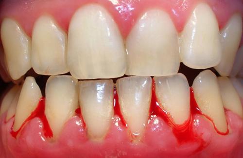 Chảy máu chân răng là bệnh gì có đáng lo ngại không?