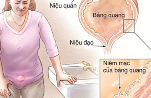 Triệu phụ nữ gặp tình trạng này mà lại không hề hay biết