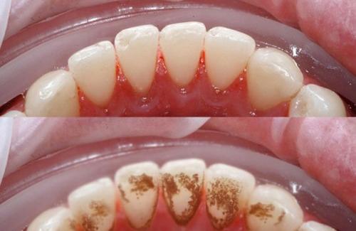Mách bạn 5 cách lấy cao răng mà không cần gặp nha sĩ