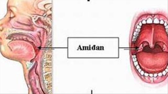 Viêm amidan biểu hiện như thế nào, có phải là nguyên nhân gây hôi miệng?