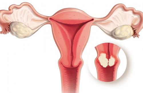 Liệt kê 8 kiểu phụ nữ dễ bị ung thư nội mạc cổ tử cung