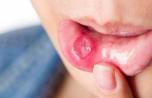 7 bài thuốc chữa nhiệt miệng đơn giản mà ít người biết đến